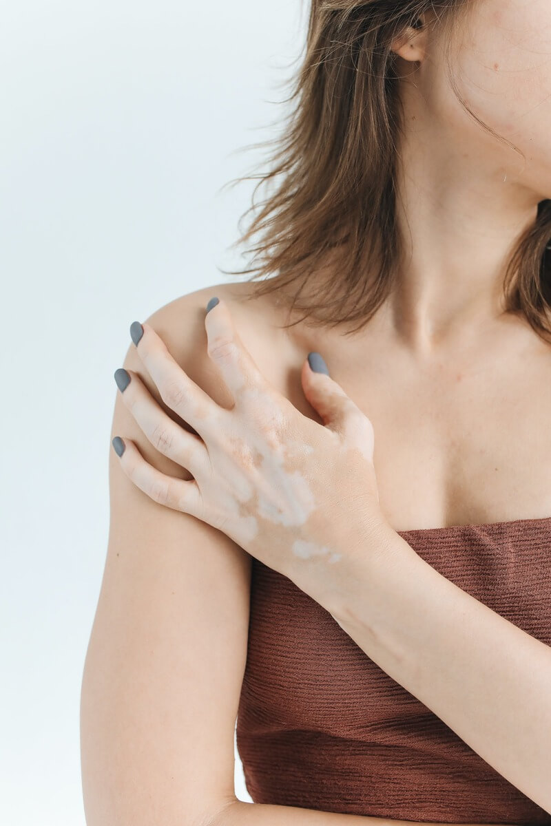 A woman with vitiligo on her hands